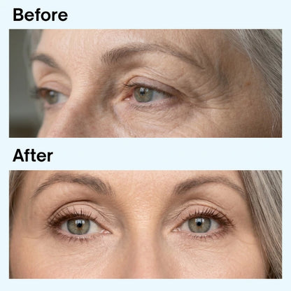 Microneedling Dissolving Eye Patches for Dark Circles, Puffiness & Fine Lines — Results in 2 Hours