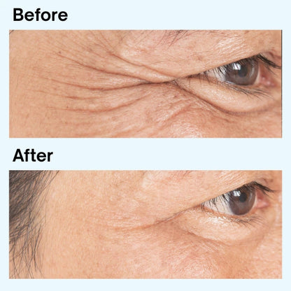 Microneedling Dissolving Eye Patches for Dark Circles, Puffiness & Fine Lines — Results in 2 Hours