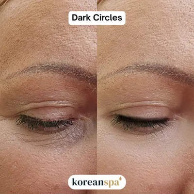 Dark circles